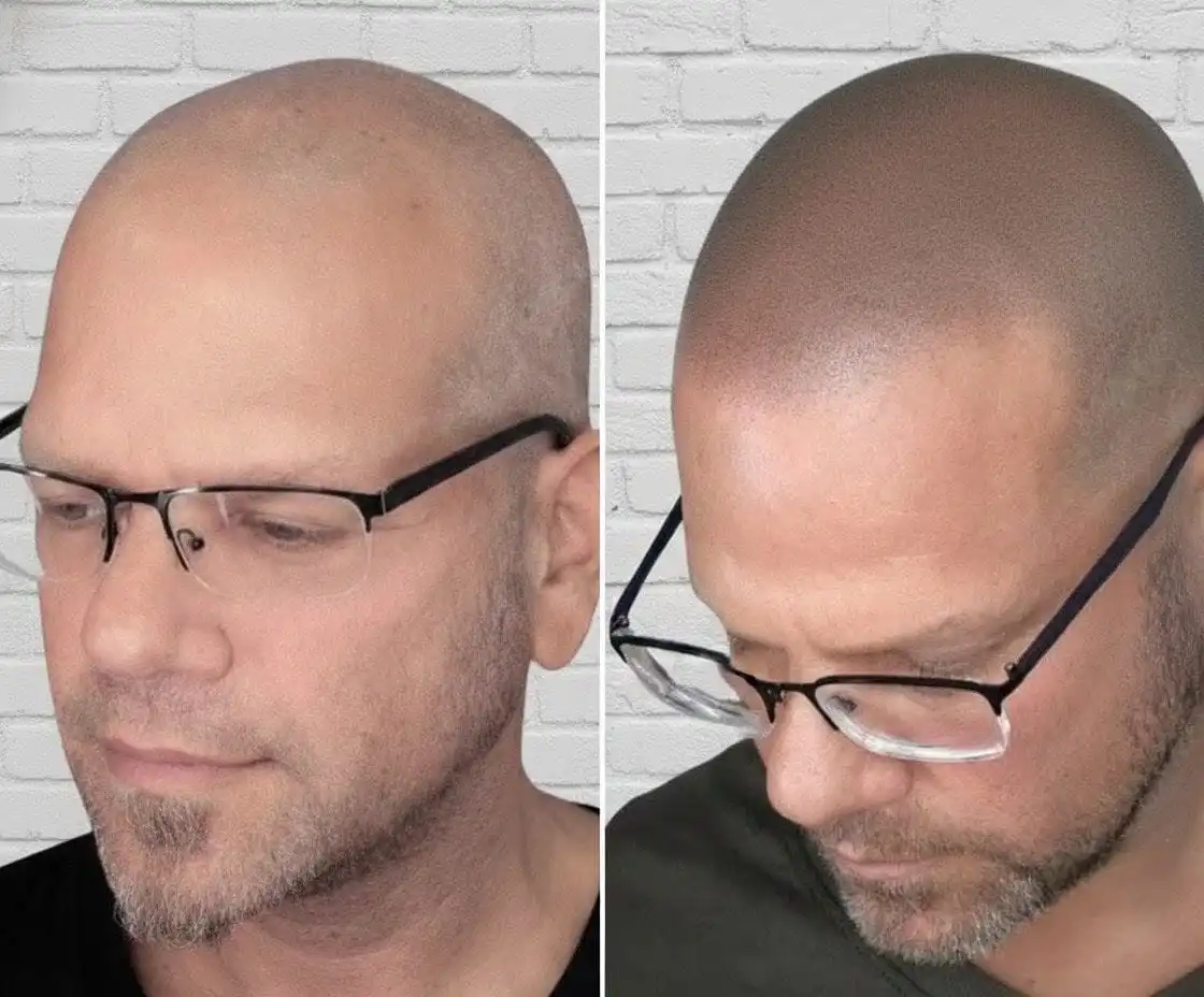 antes y despues en micropigmentacion capilar