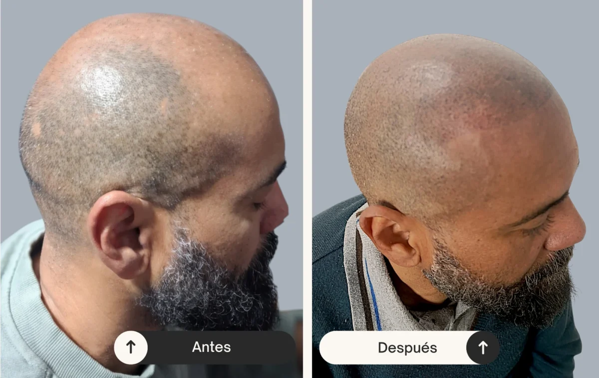 Micropigmentacion capilar en zona de valencia